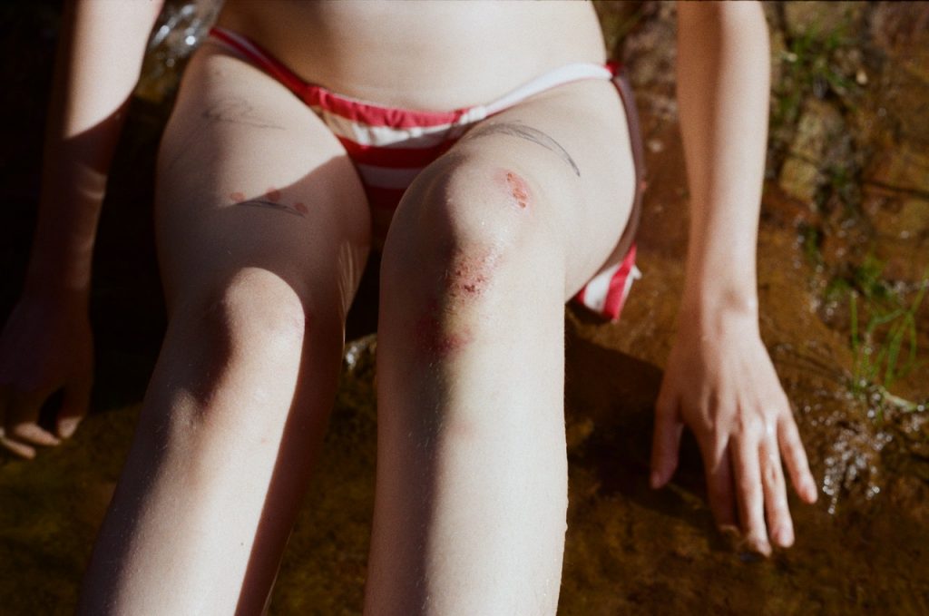 Moretones en tu cuerpo y el hígado