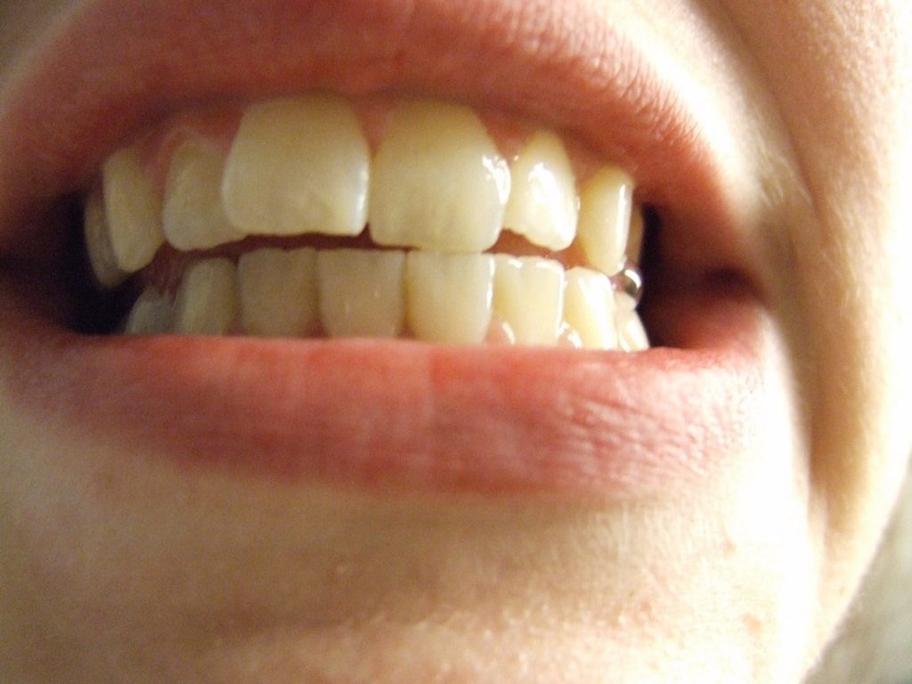 ¿Cómo Puede Combatir La Sensibilidad En Los Dientes?