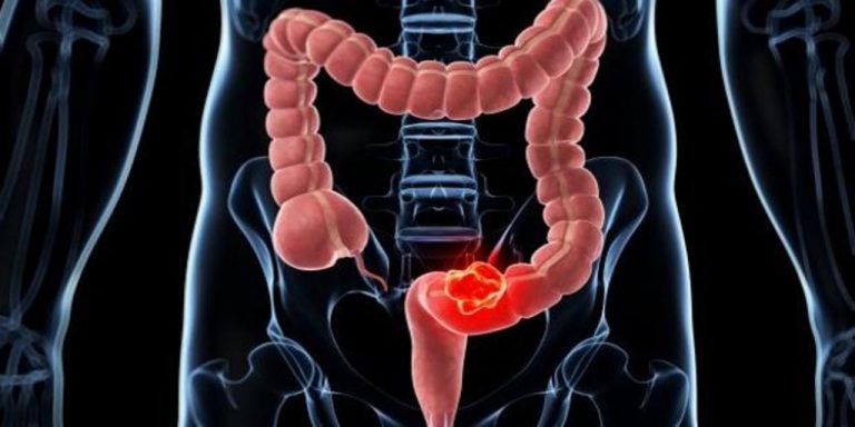 Un estudio analiza la relación entre la dieta y el microbioma con el cáncer colorrectal