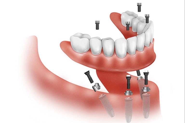 All On 4 y All On 6, las prótesis dentales híbridas de Clínica Dental Ruiz de Gopegui que devuelven la sonrisa en 24 horas