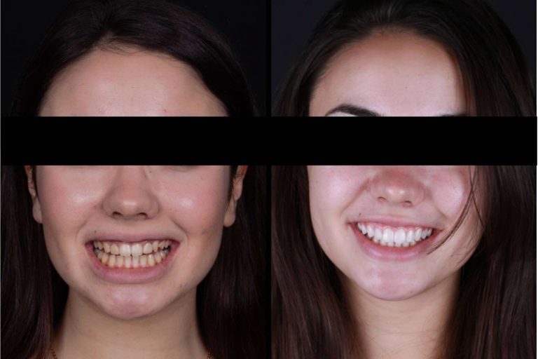Las múltiples ventajas de las carillas dentales, de la mano de Carillas Wikend®