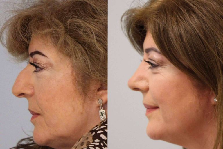 El Dr. Pérez Villar aconseja qué hacer antes de pasar por una rinoplastia ultrasónica