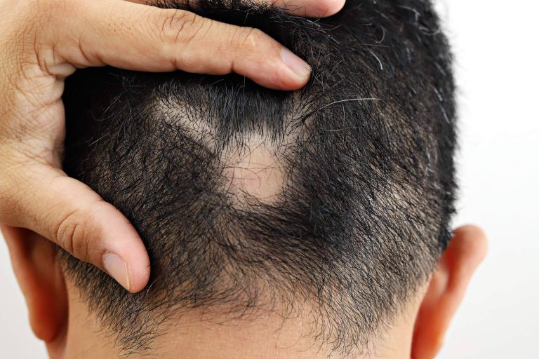 Combatir la alopecia areata con Saw Palmetto y su tratamiento