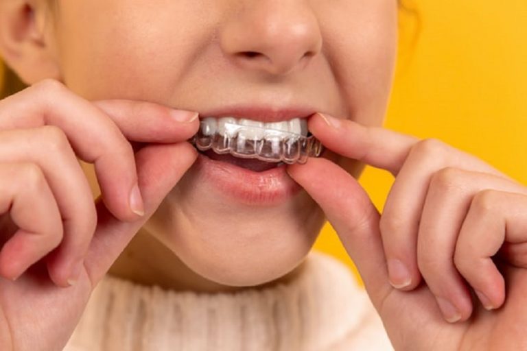 Invisalign, el tratamiento que está de moda entre las influencers