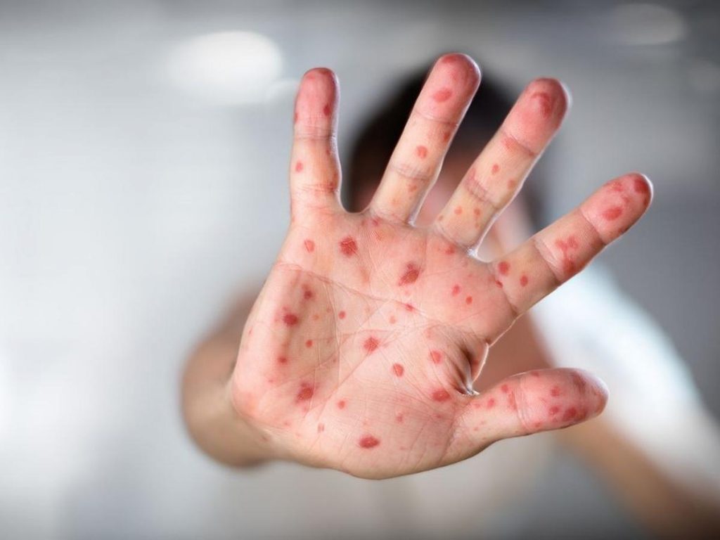 ¿A quiénes se le aplicará la vacuna contra la viruela del mono?