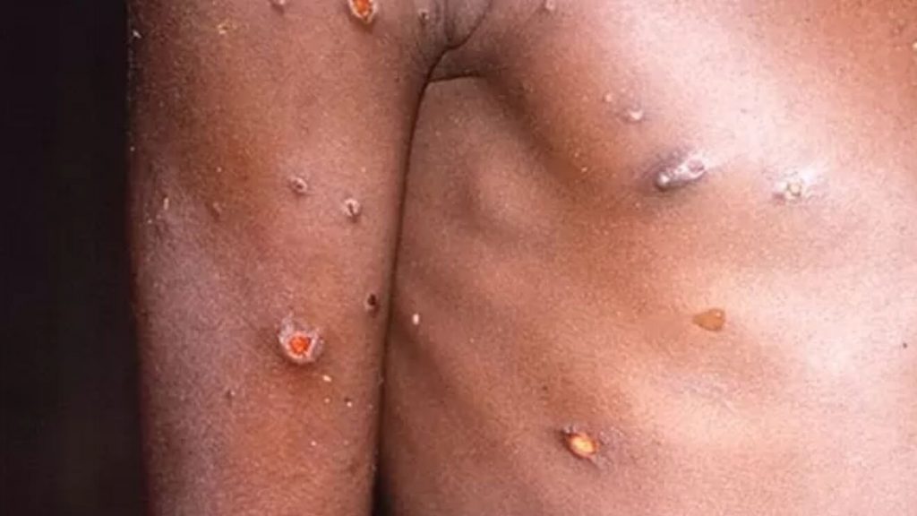 Pandemia: España Es El País Con Más Casos Registrados