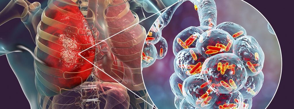 ¿Cuáles Ambientes Nocivos Afectan A Nuestros Pulmones De Manera Más Seguida?