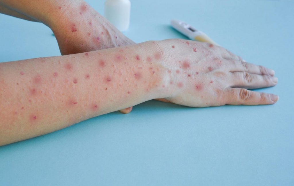 Pandemia: Síntomas De La Viruela Del Mono