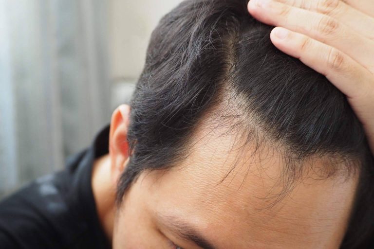 ¿En qué consiste el tratamiento de micropigmentación capilar?, por Élite Capilar