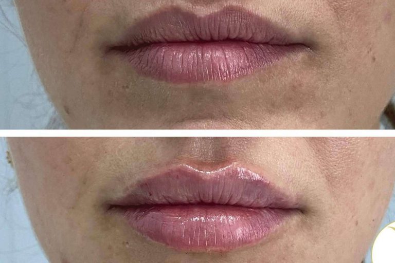 Adiblips, la técnica de la Clínica Yasmin para el aumento de labios con ácido hialurónico