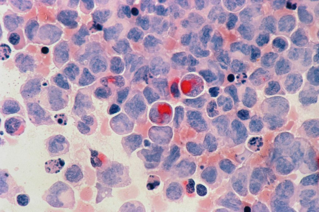 Estas Son Las Personas Más Propensas A Contraer Cáncer