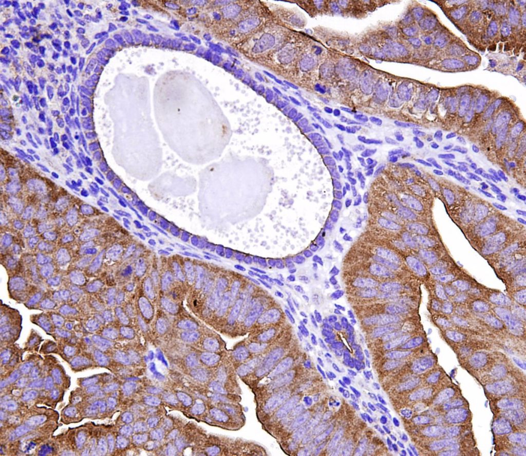 ¿Cuál es el examen que puede detectar el cáncer de endometrio?