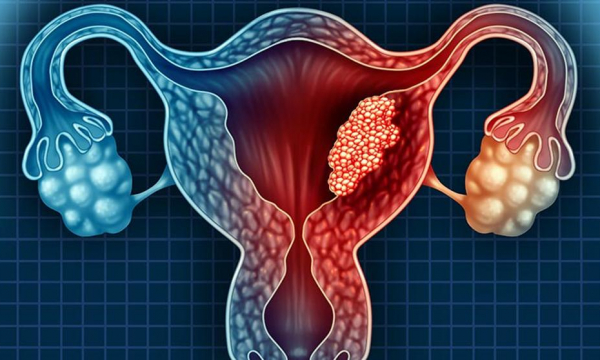 ¿Cómo se puede diagnosticar tempranamente el cáncer de endometrio?