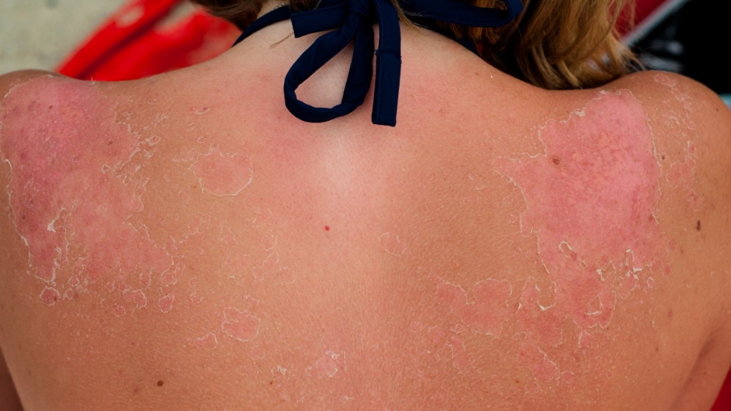La dermatitis