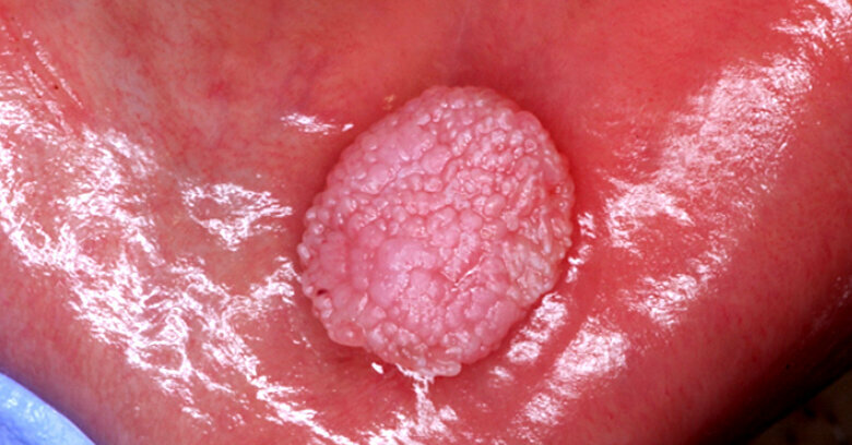 Candiloma O Hpv