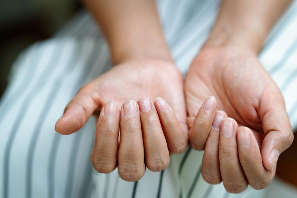 La enfermedad de Raynaud