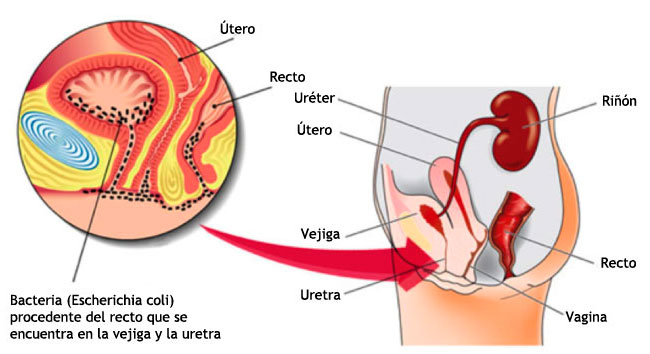 ¿La Cistitis Es Una Infección Que Sólo Sufren Las Mujeres?