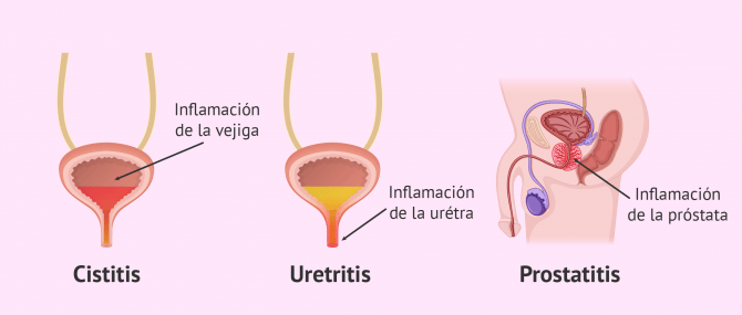 ¿Qué Síntomas Manifiesta Una Persona Que Tiene Cistitis?