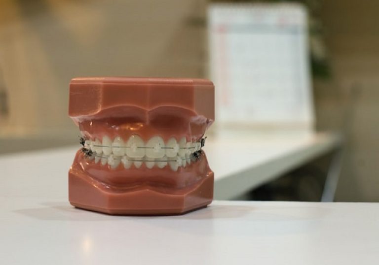 Estos son los precios de los brackets en España