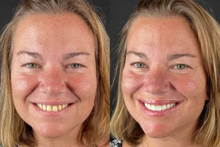 Con Carillas Wikend® es posible ponerse carillas dentales sin tallado de dientes en Madrid