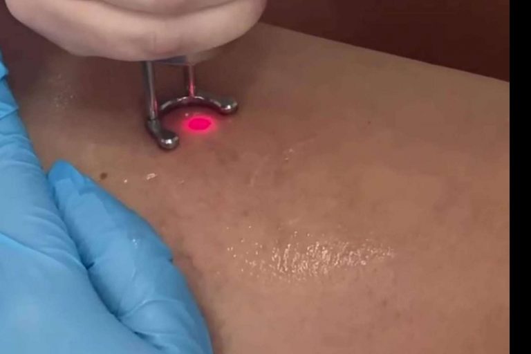 Eliminar las varices con la doctora Yasmin Al Adib en su clínica situada en Sevilla