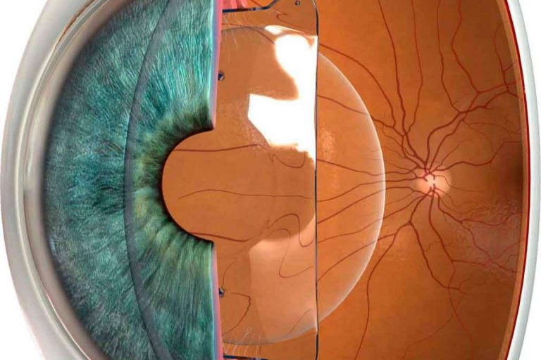 ¿Cómo funciona la cirugía refractiva?