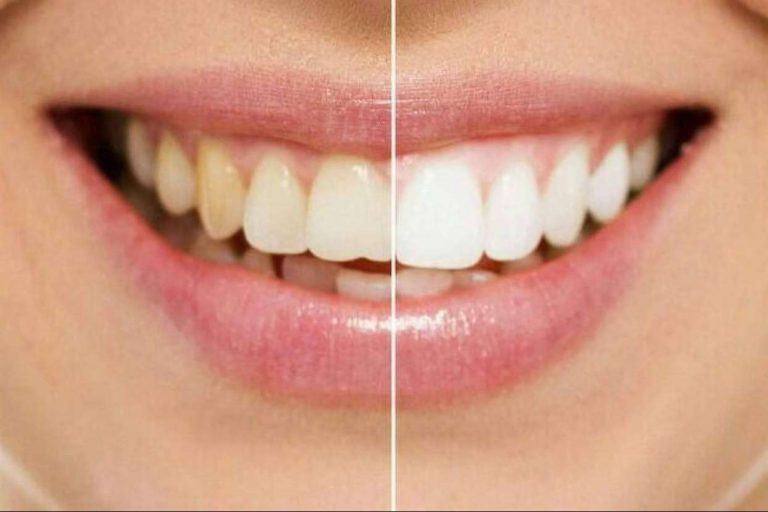 Los servicios de blanqueamiento dental de Cleardent