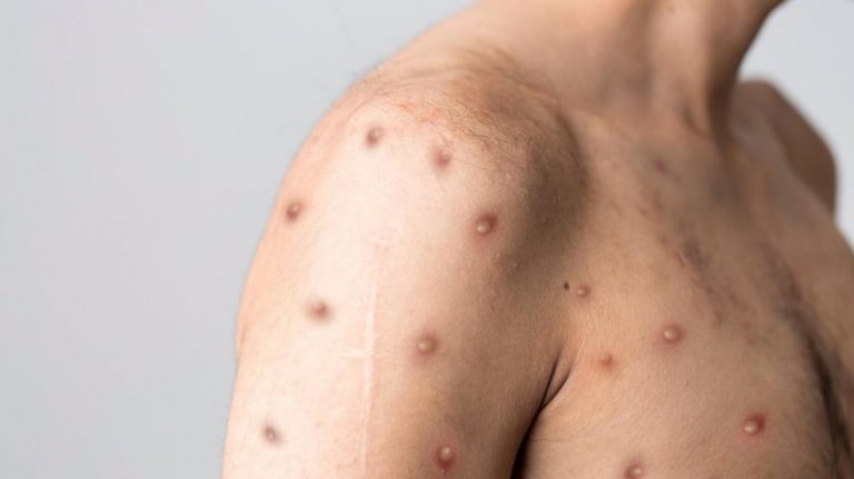 En la última quincena se han diagnosticado 23 casos de viruela del mono en toda Europa