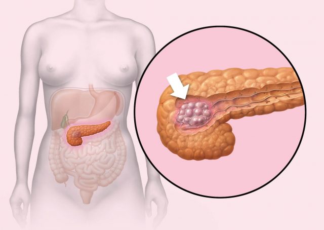 Cáncer de páncreas: señales que te avisan de que debes ir al médico