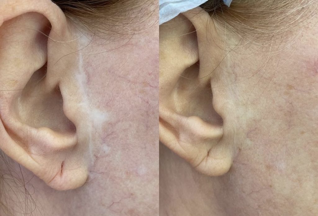 Oculta Llega A Madrid Para Disimular Aquellas Imperfecciones De La Piel Que Aún No Tenían Solución – Noticias Empresariales 2 Cicatriz Lifting Facial