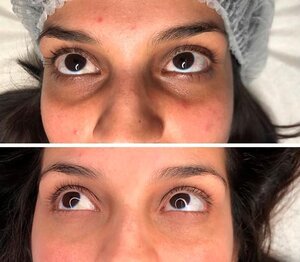 Oculta Llega A Madrid Para Disimular Aquellas Imperfecciones De La Piel Que Aún No Tenían Solución – Noticias Empresariales 3 Ojeras Pigmentadas
