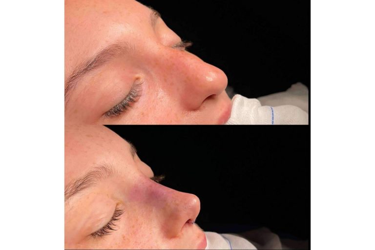 Los aspectos más importantes a la hora de elegir entre los diferentes tipos de rinoplastia, por el Dr. Álvaro Pérez-Villar
