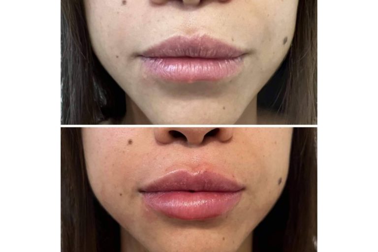 ¿Se puede conseguir un aumento de labios en Madrid con resultados naturales?, por la Dra. Cecilia Arthur