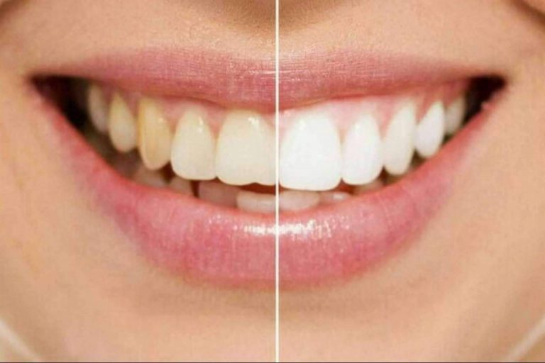 Escoger carillas o blanqueamiento para conseguir una sonrisa perfecta