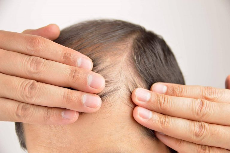 Trasplante de cabello con la técnica Zafiro FUE en Benidorm, Elche y Villena y Madrid de la mano de Élite Capilar