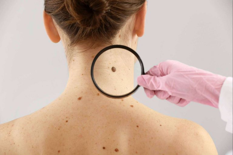 Eliminación de verrugas y lunares con tecnología de vanguardia en el Centro Médico El Pilar