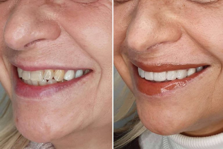 Alineación dentaria sin ortodoncia, por Dentinova