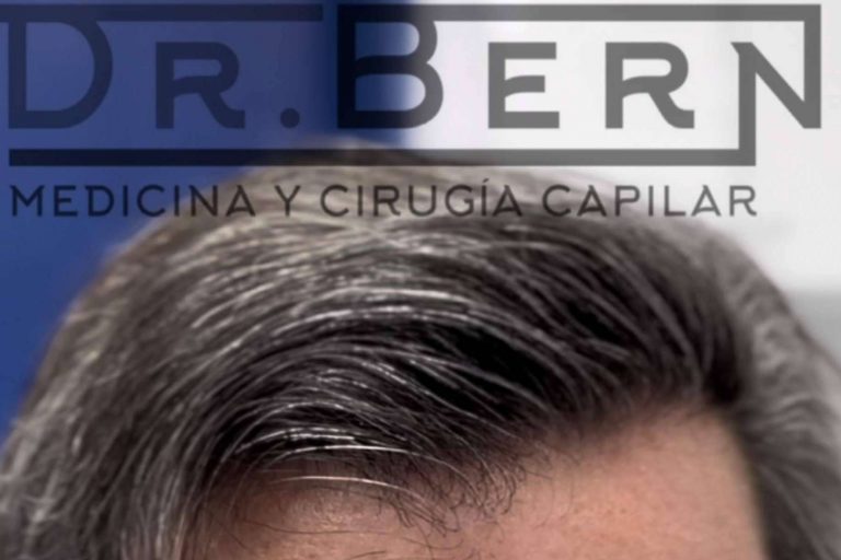 Dr. Bern, premiado por perfeccionar la técnica FUE