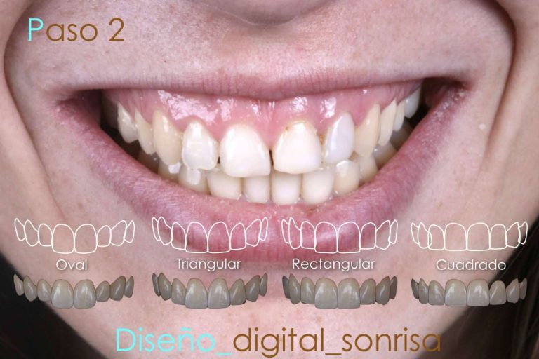 ¿Por qué realizarse un diseño de sonrisa en la Clínica Dental Ruiz de Gopegui?