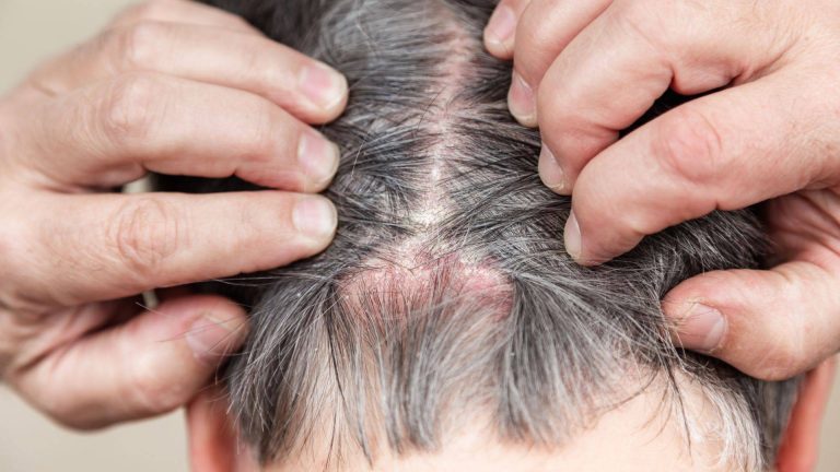 ¿Pueden contagiar los perros la alopecia por tiña del cuero cabelludo?
