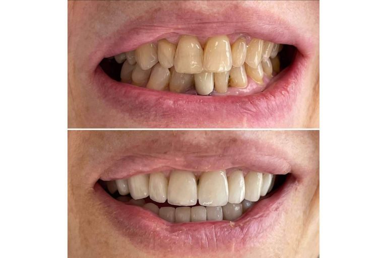 Todo lo que se debe saber sobre las microcarillas dentales, por la Clínica MG Dental & Estética Facial