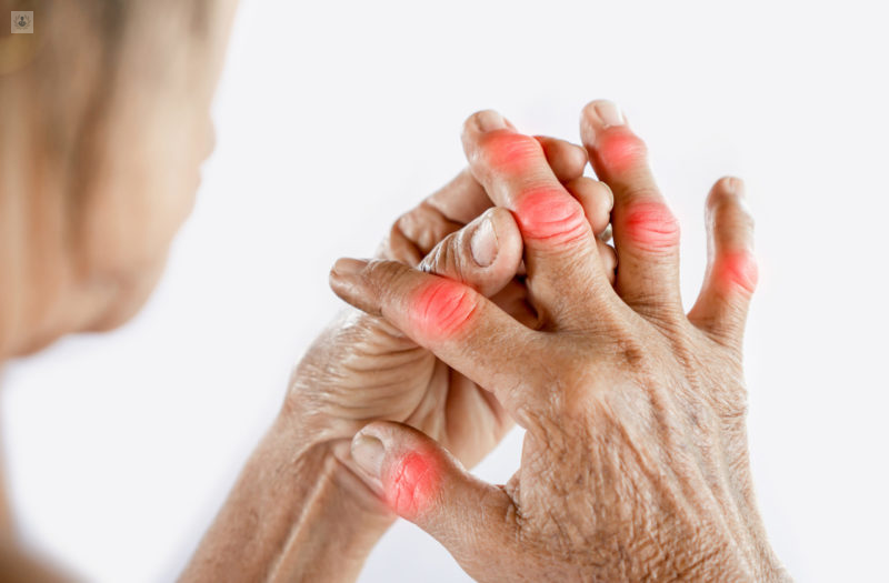 ¿Qué es la artritis reumatoide?