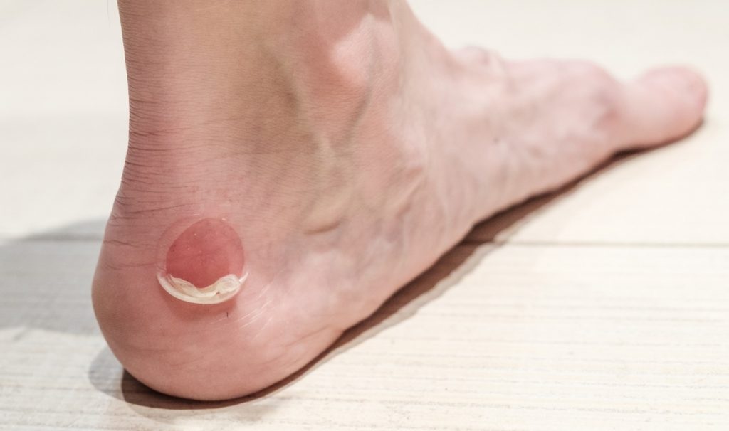 Ampollas en los pies: el truco para borrarlas en 24 horas 61 ¿Qué es son las ampollas?