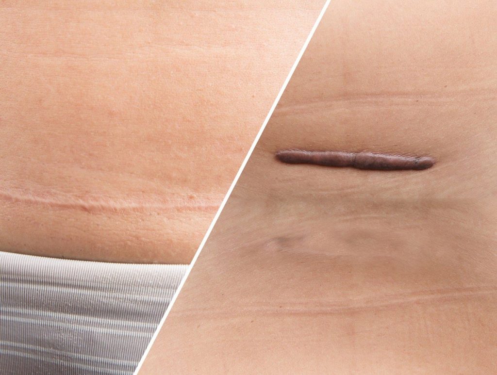 ¿Qué Se Hacer Cuando Las Heridas Ya Estan Blancas?