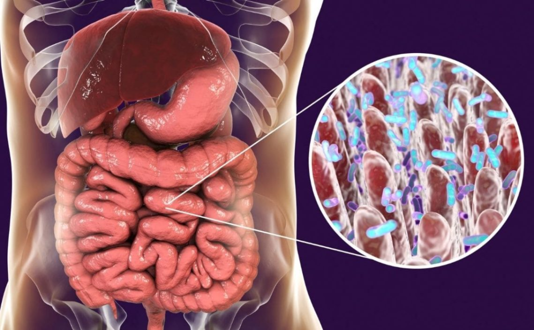¿Qué es el Síndrome de colon irritable?