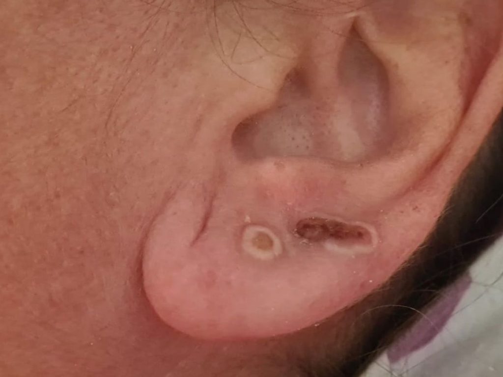 Señales de que el piercing que llevas está infectado 15 Mide la temperatura del área de la perforación