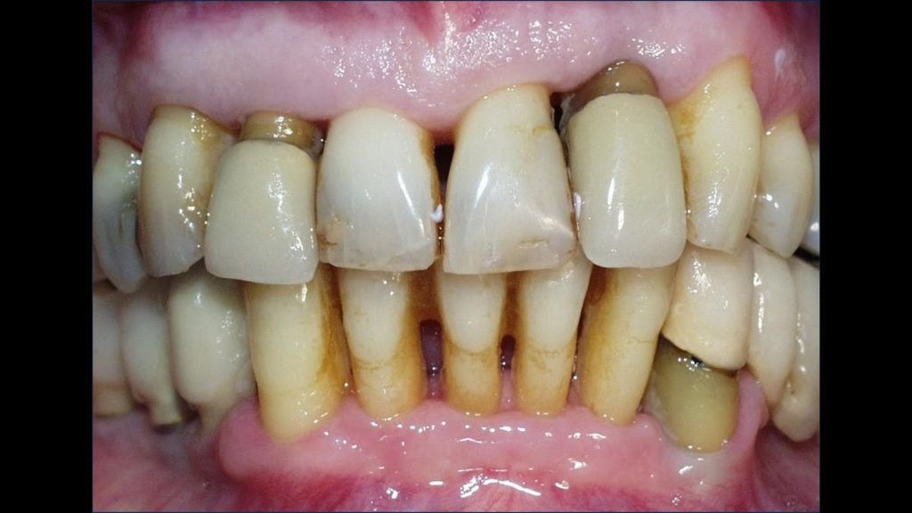 Si tienes problemas con las encías puedes tener estas enfermedades 4 Periodontitis