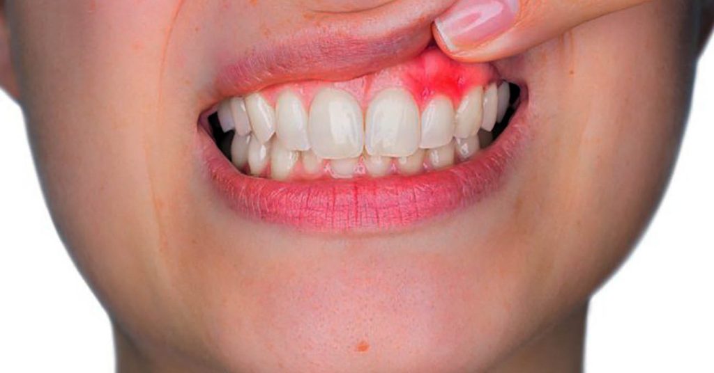 Si tienes problemas con las encías puedes tener estas enfermedades 3 Gingivitis