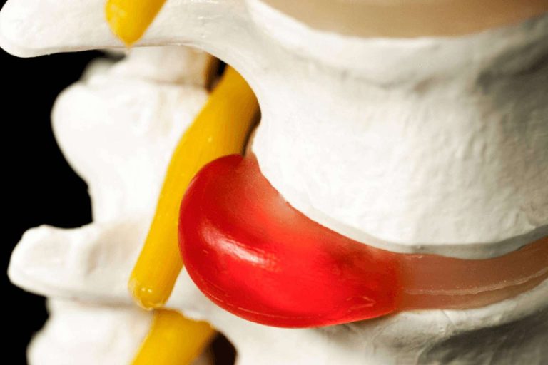 Las hernias de disco pueden mejorar sin necesidad de cirugía gracias a las últimas tecnologías avanzadas