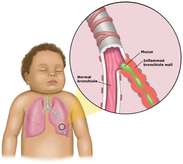 Bronquiolitis En Niños